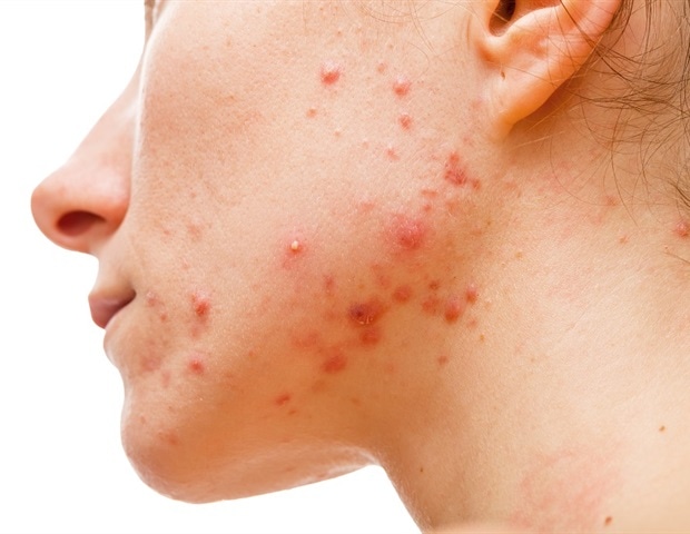 Study Reveals Widespread Unrecognized Acne Among 35-year-old Finnish Women