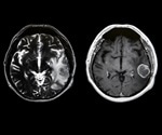 Micro-MRI in Cancer Research