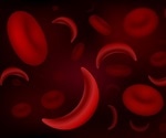 New technology precisely diagnoses sickle cell disease in a minute