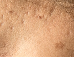 FDA shares safety guidance for people considering microneedling