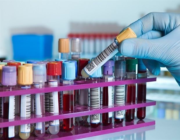 New blood biomarker tracks brain injury progression after ischemic stroke