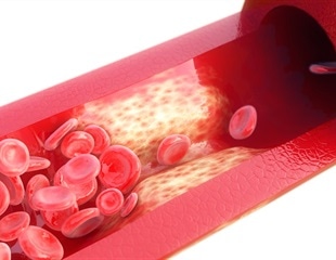 REACT study maps widespread silent atherosclerosis across adult lifespan