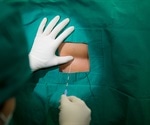 General anesthesia may lower recurrence risk in patients with HCC