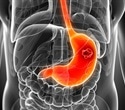 Early detection of stomach cancer shows major progress