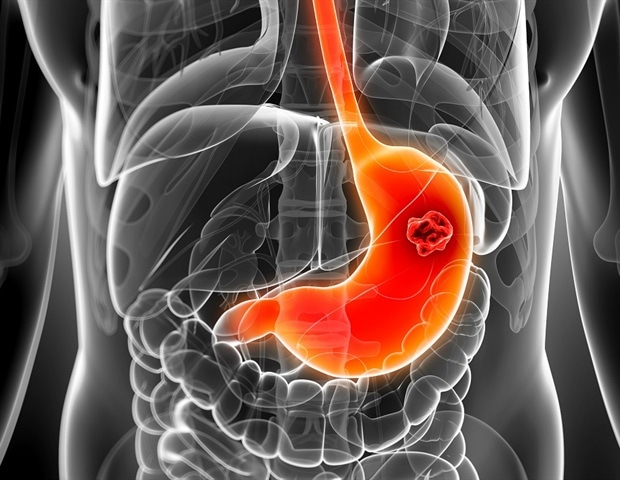 Long-term proton pump inhibitor use not linked to stomach cancer