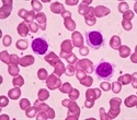 Multi-million dollar grants aim to advance hairy cell leukemia research