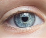 Dry eye disease negatively affects patients' health and vision related quality of life