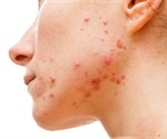 Microbiome and Disease