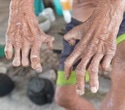 WHO and Novartis extend partnership to eliminate leprosy for another 5 years