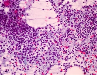 DNASE1L2 identified as a dynamic biomarker for TB progression