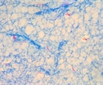 Fight against TB threatened by drug resistance