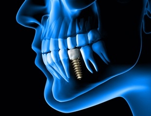 Tufts researchers develop dental implant that mimics real tooth function