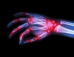 New compounds reduce inflammation without weakening immune defense