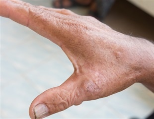 Seeking solutions to treat scleroderma