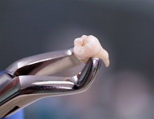 Over-the-counter pain relievers outperform opioids after wisdom tooth extraction