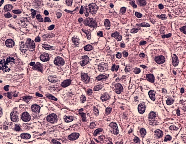 Targeting a key enzyme could reverse early Parkinson's effects