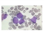Southampton researchers find new approach to reverse treatment resistance in lymphoma patients