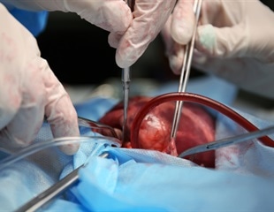 Intravenous iron before heart surgery cuts transfusion needs