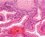 Barrett's Esophagus Preventing Progression