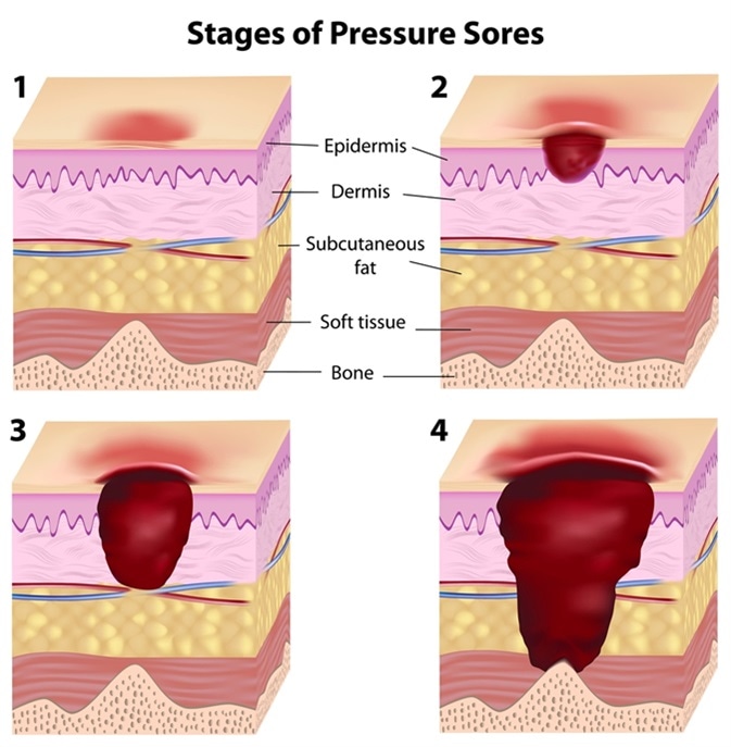 Pressure Ulcer Prevention and Treatment