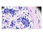 Scientists gain new insight into aggressive breast cancers