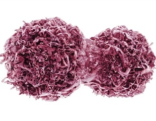 Pembrolizumab combination therapy improves survival in recurrent endometrial cancer patients