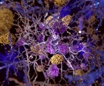 Scientists develop new mechanism that helps decode amyloid plaque formation in brains of Alzheimer's patients