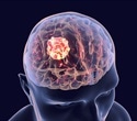 Study identifies key metric for safe blood brain barrier opening in glioblastoma patients