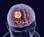 Glitazone drug use by diabetic patients associated with lower risk of primary and secondary brain cancer