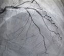 Evolocumab fails to reduce vein graft disease after coronary artery bypass surgery