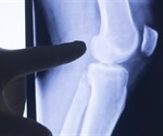 Hispanic mortality paradox found in RA patients