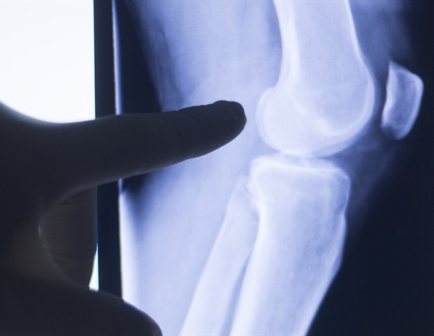 New study maps cellular fingerprints driving childhood arthritis