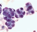 Lipid droplet protein perilipin 2 linked to poor prognosis in lung cancer