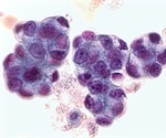 Study compares five-year DFS and OS rates for patients with AIS and MIA