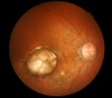 New intramuscular mRNA vaccine offers easier alternative to treat neovascular eye diseases