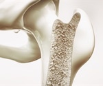 InSightec seeks FDA premarket approval for ExAblate treatment of pain palliation of bone metastases