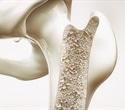 PAI-1 may be a promising therapeutic target for preventing age-related muscle and bone loss