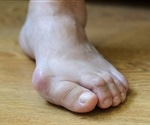 Bunion deformity more frequent in women, greatly reduces general, foot-specific HRQOL