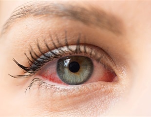 Researchers uncover mechanism linking skin inflammation to body-wide allergies