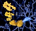 Cell messengers signal amyloid plaque buildup in obese individuals