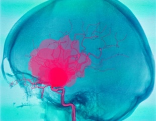 Physics-informed AI framework improves aortic aneurysm stress prediction
