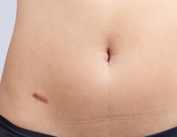 semaglutide and appendicitis Non-surgical approach can be a routine treatment option for uncomplicated  appendicitis cases