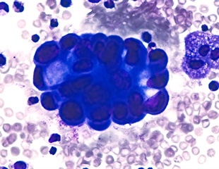 Circular eccDNA shows potential to predict early-stage LUAD recurrence
