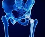 Antimicrobial Properties of Bioactive Glass-Coated Implants