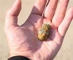 How do gallstones form?