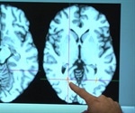 Birth control pills shrink hypothalamus