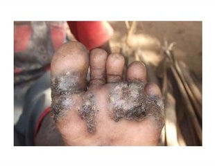 Simple prevention methods could reduce tungiasis in children, study suggests