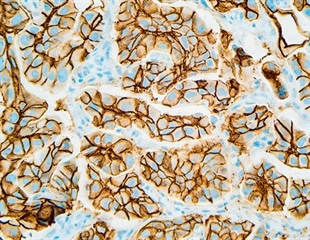 Xuebijing injection reduces inflammation and ferroptosis in acute lung injury