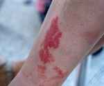 Leukocytoclastic Vasculitis
