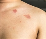 Treatment of ringworm